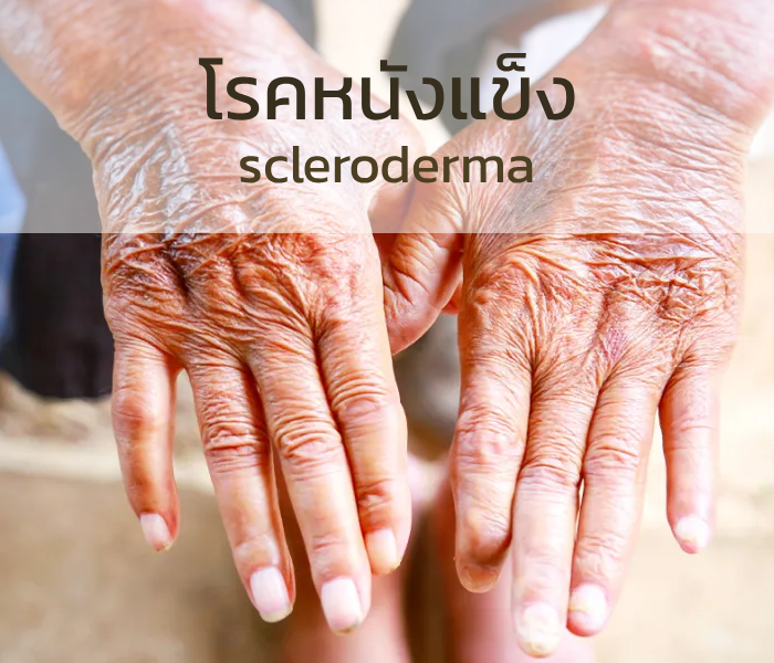 scleroderma-photo โรคผิวหนังแข็ง