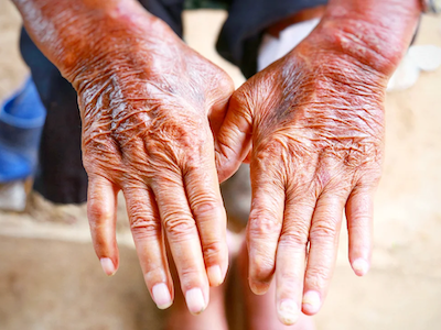 Systemic-Sclerosis อาการโรคหนังแข็งทั่วร่างกาย