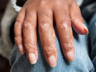 systemic sclerosis อาการผิวหนังแข็งที่นิ้วมือ